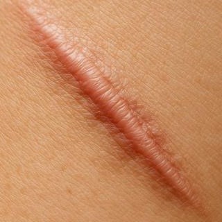 Scar Tissue: What It Does to Your Body (And How Massage Can Help)