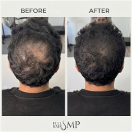Salon, Barber & Beauty Shops SMP - Packages - Men’s Hair Density SMP Package