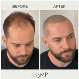 Salon, Barber & Beauty Shops SMP - Packages - Shaved Head SMP